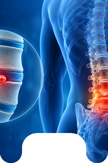 آیا بیرون زدگی دیسک کمر با فیزیوتراپی درمان می‌شود؟